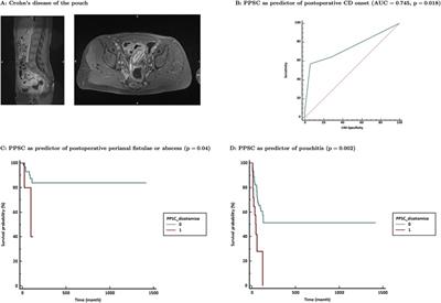 Validation of the Padova Prognostic Score for Colitis in Predicting Long-Term Outcome After Restorative Proctocolectomy